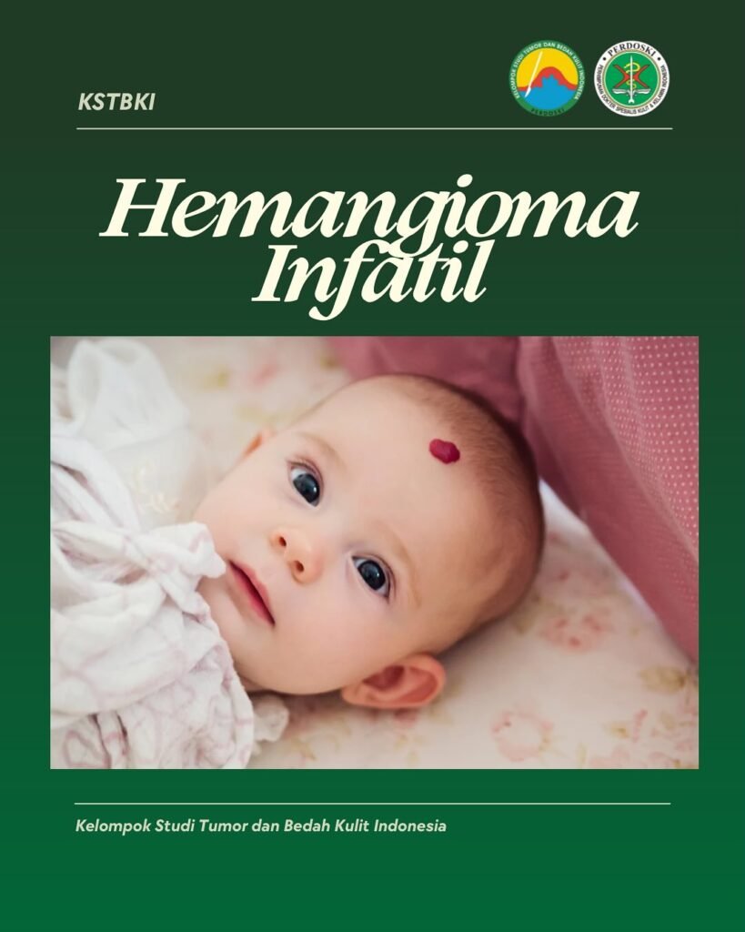 Hemangioma Infantil 5