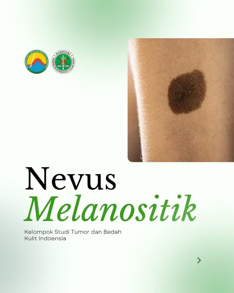 Nevus melanositik 1
