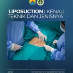 Kenali Teknik dan Jenis Liposuction: Mana yang Sesuai dengan Kebutuhan Anda?