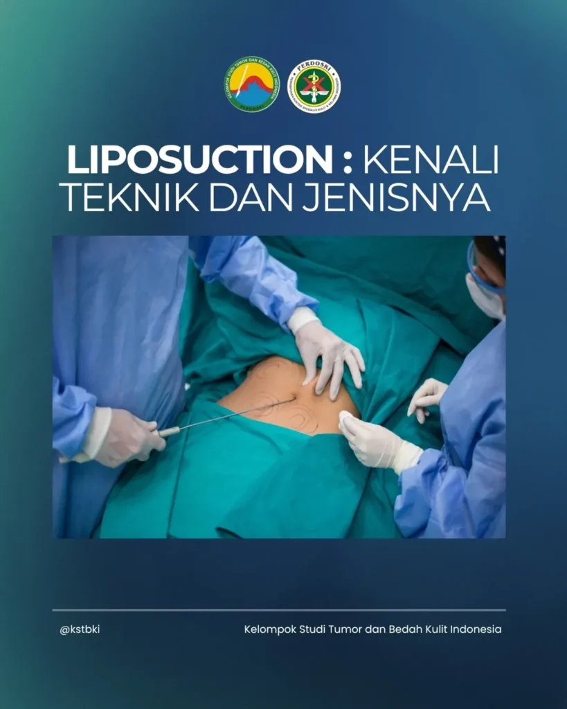 KSTBKI Liposuction8
