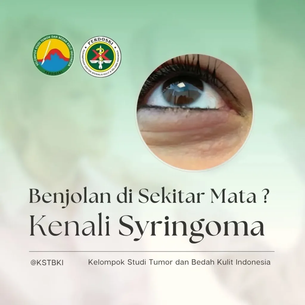 Benjolan Kecil di Sekitar Mata? Kenali Syringoma, Tumor Jinak dari Kelenjar Keringat
